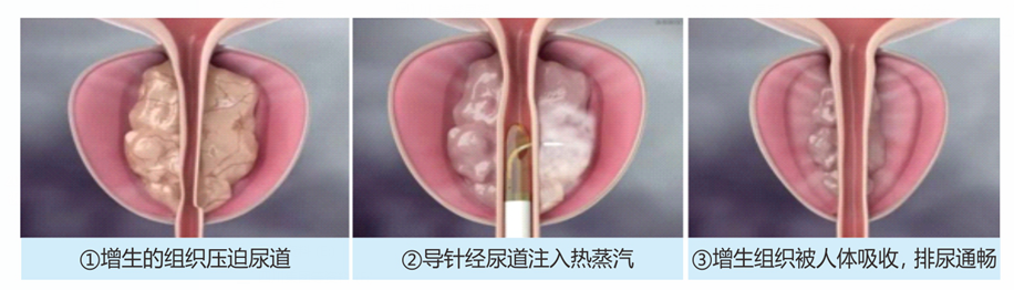 四川首家！“美国波科Rezūm瑞梦培训中心”落户四川结石病医院，前列腺增生患者的福音(图10)