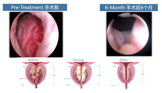 【男性健康日】关注男性健康，护好男性“生命腺”！(图3)