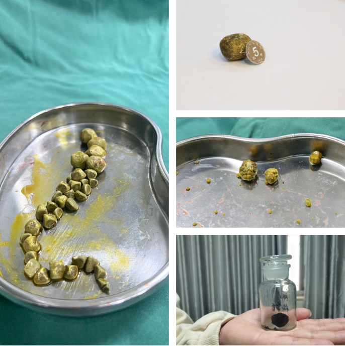 全力以赴,医有保障!四川结石病医院积极应对春季胆结石就诊高峰(图2) 全力以赴,医有保障!四川结石病医院积极应对春季胆结石就诊高峰(图2)