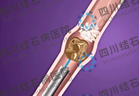 成都碎石医院:做了体外碎石居然没碎干净?真相到底是什么?(图1) 成都碎石医院:做了体外碎石居然没碎干净?真相到底是什么?(图1)