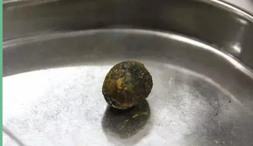 成都胆结石医院提醒您:不吃早餐,真的很容易被这个病“找上门”!(图1) 成都胆结石医院提醒您:不吃早餐,真的很容易被这个病“找上门”!(图1)