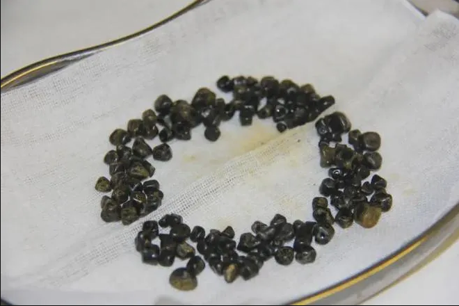 四川保胆取石医院又现一例多发胆囊结石,整整143颗胆结石成功保胆!(图1) 四川保胆取石医院又现一例多发胆囊结石,整整143颗胆结石成功保胆!(图1)