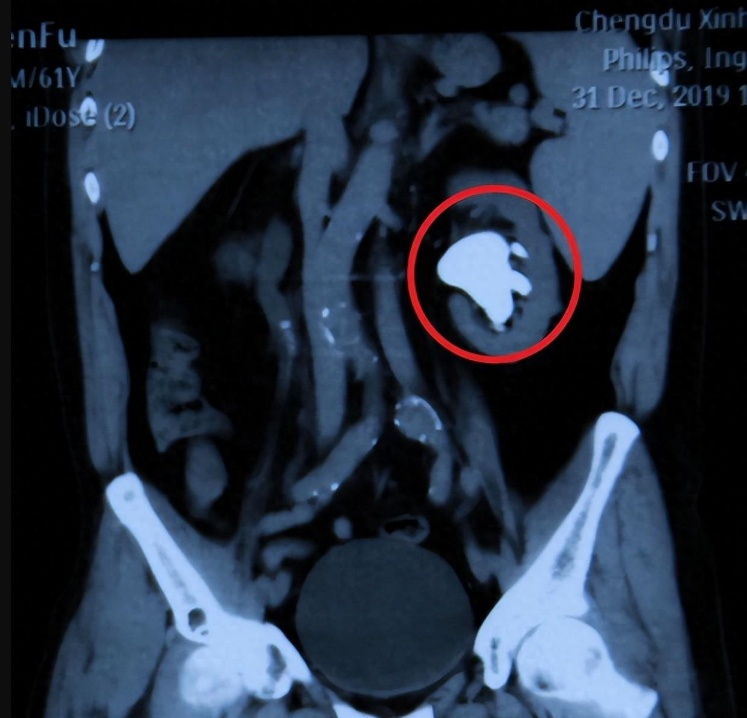 成都肾结石医院案例:单肾结石变双肾结石,肾脏险被占满!(图1) 成都肾结石医院案例:单肾结石变双肾结石,肾脏险被占满!(图1)