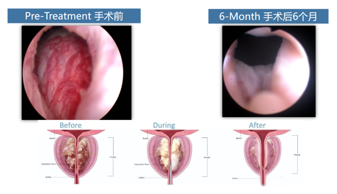 四川瑞梦诊疗中心：尿频、尿急、排尿困难？小心前列腺增生！(图2)