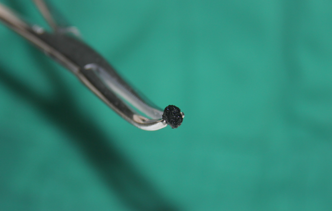 遂宁7岁男孩遭胆结石困扰,父母拒绝切胆求助四川结石病医院!(图1) 遂宁7岁男孩遭胆结石困扰,父母拒绝切胆求助四川结石病医院!(图1)