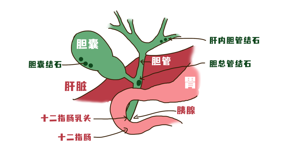 胆结石为何总在夜间“捣乱”？疼痛缓解后还要治疗吗？【成都胆结石医院】(图2)