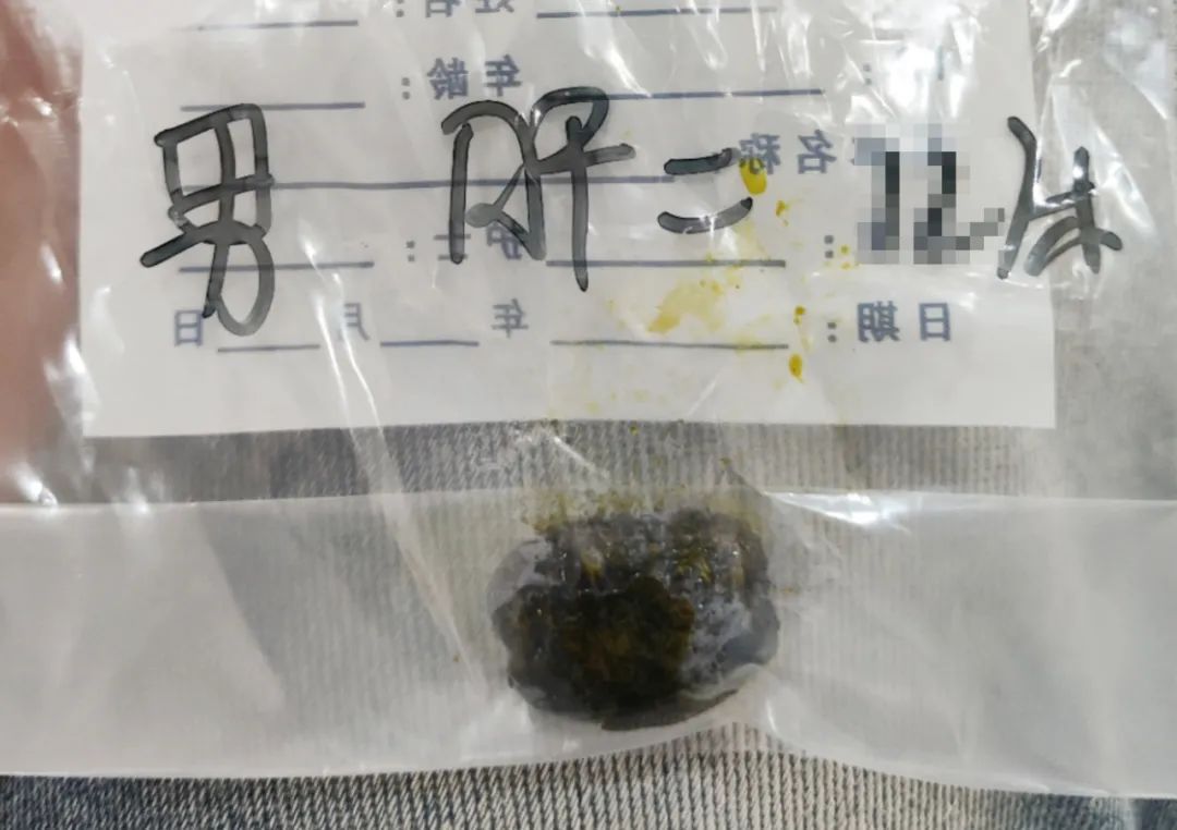 甘肃患者跨省到四川结石病医院圆保胆梦,患者:找对专业医院最关键(图2) 甘肃患者跨省到四川结石病医院圆保胆梦,患者:找对专业医院最关键(图2)