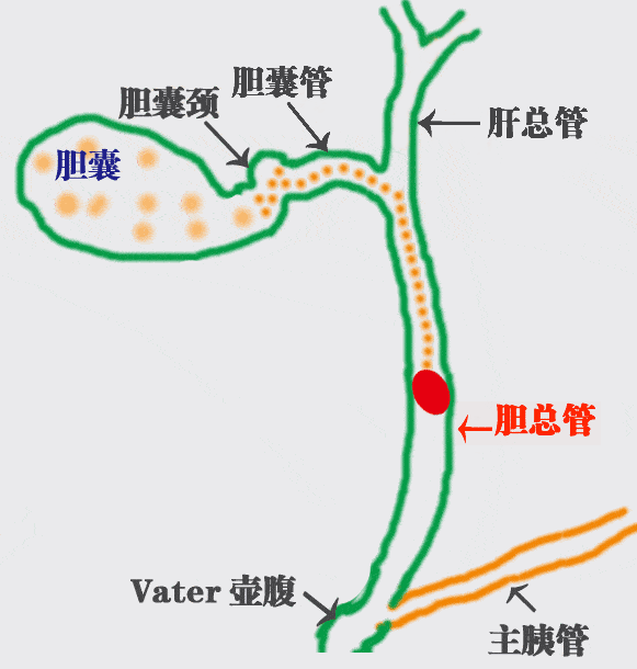 胆囊结石想靠碎石排石?四川结石病医院陈红春主任:此路行不通,别踩坑!(图2) 胆囊结石想靠碎石排石?四川结石病医院陈红春主任:此路行不通,别踩坑!(图2)