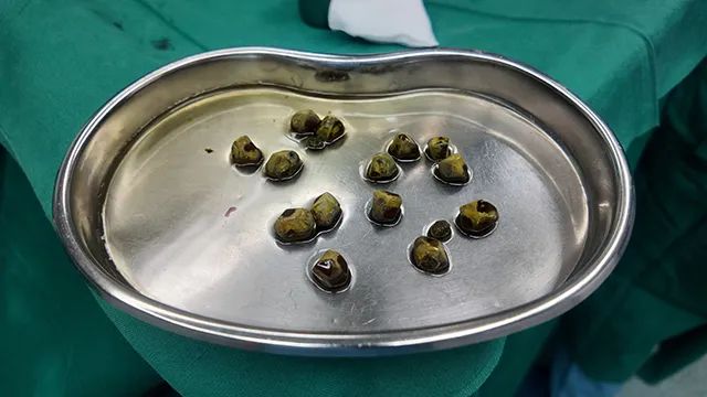 胆囊结石想靠碎石排石?四川结石病医院陈红春主任:此路行不通,别踩坑!(图3) 胆囊结石想靠碎石排石?四川结石病医院陈红春主任:此路行不通,别踩坑!(图3)