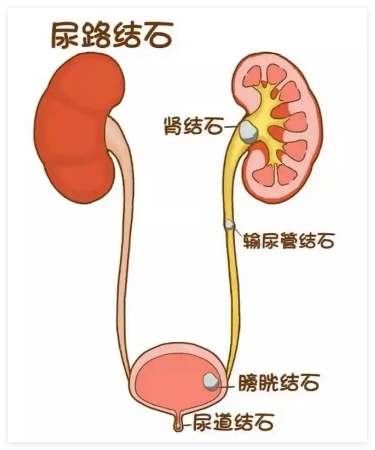 当心!出现这些症状可能提示泌尿结石,务必及时排查!【成都24小时碎石医院】(图1) 当心!出现这些症状可能提示泌尿结石,务必及时排查!【成都24小时碎石医院】(图1)