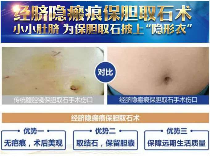 胆结石无症状期,保胆有哪些好处?何明刚主任为你全面详解【四川胆结石专科医院】(图4) 胆结石无症状期,保胆有哪些好处?何明刚主任为你全面详解【四川胆结石专科医院】(图4)