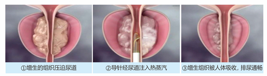瑞梦3分钟解除“前腺”危机:以科技“蒸”功夫守护银龄安康丨四川瑞梦诊疗中心(图3) 瑞梦3分钟解除“前腺”危机:以科技“蒸”功夫守护银龄安康丨四川瑞梦诊疗中心(图3)