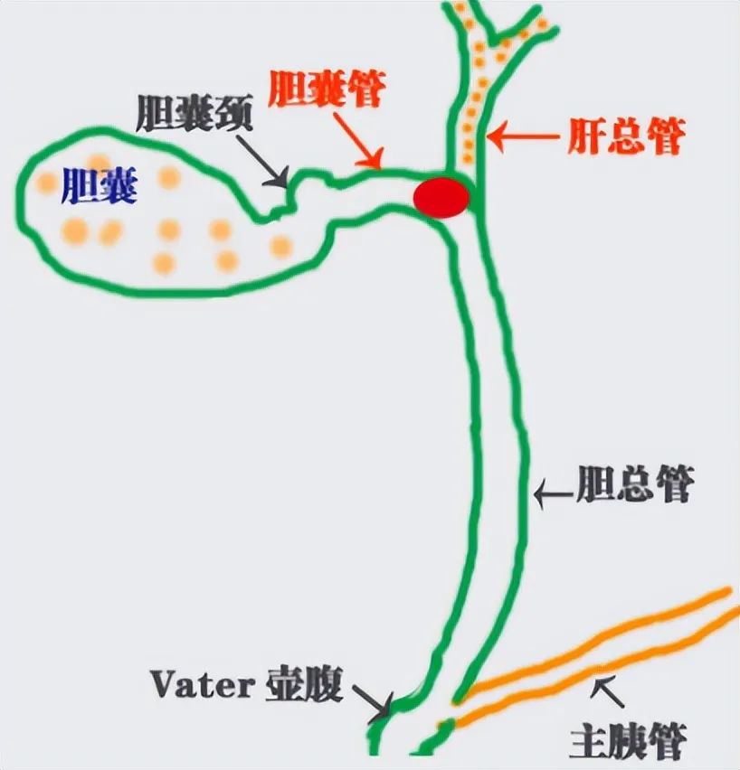 胆结石小≠小事情?轻视胆结石,后果远比你想象的严重【四川胆结石专科医院】(图2) 胆结石小≠小事情?轻视胆结石,后果远比你想象的严重【四川胆结石专科医院】(图2)