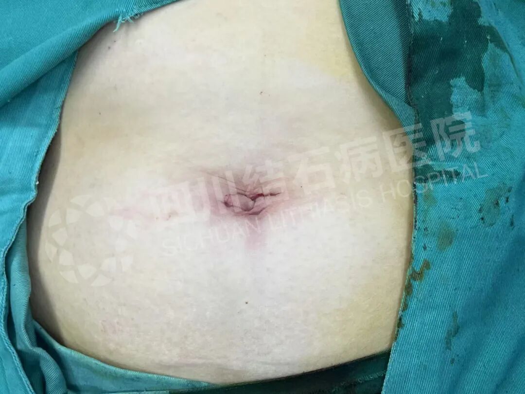 怕留疤？怕切胆？经脐隐瘢痕技术实现“鱼与熊掌兼得”【四川结石病医院】(图2)