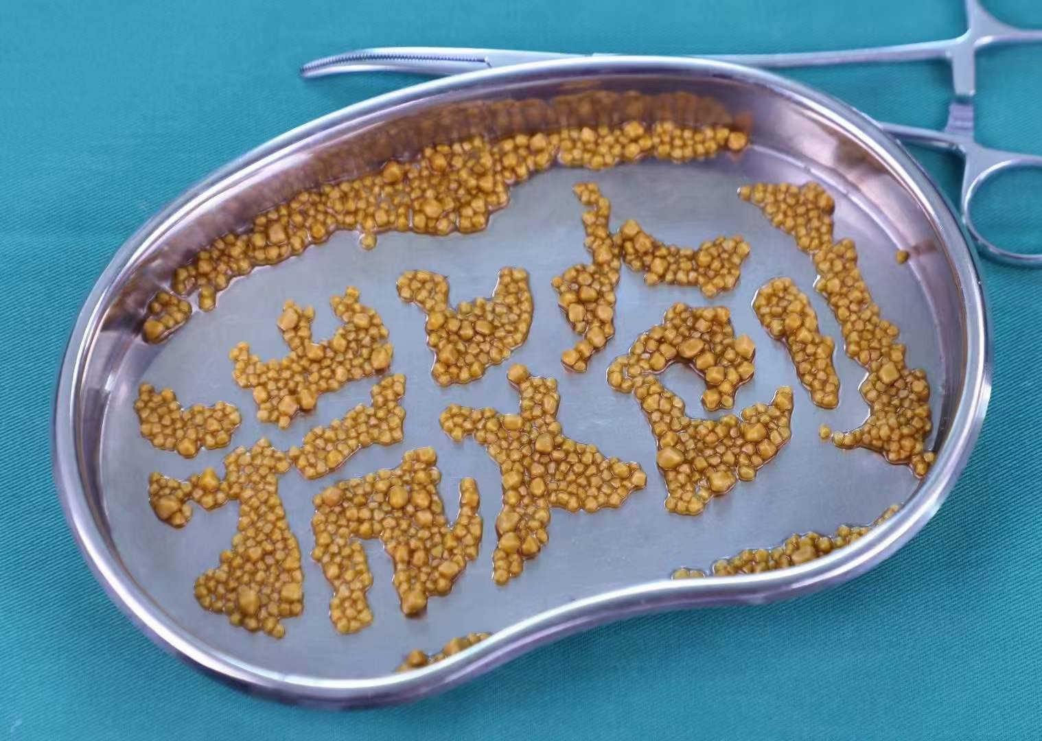 一文读懂肾结石5个发展阶段，早发现、早治疗，越到后面越危险！(图3)