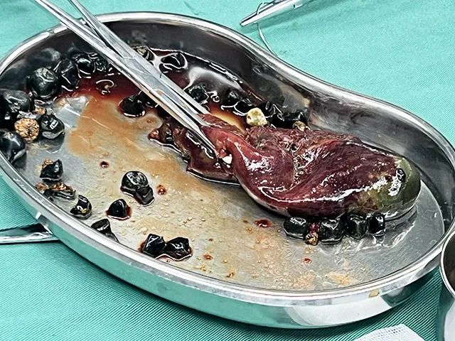 结石不痛=安全？大错特错！何明刚主任揭穿胆囊结石的“伪装”(图2)