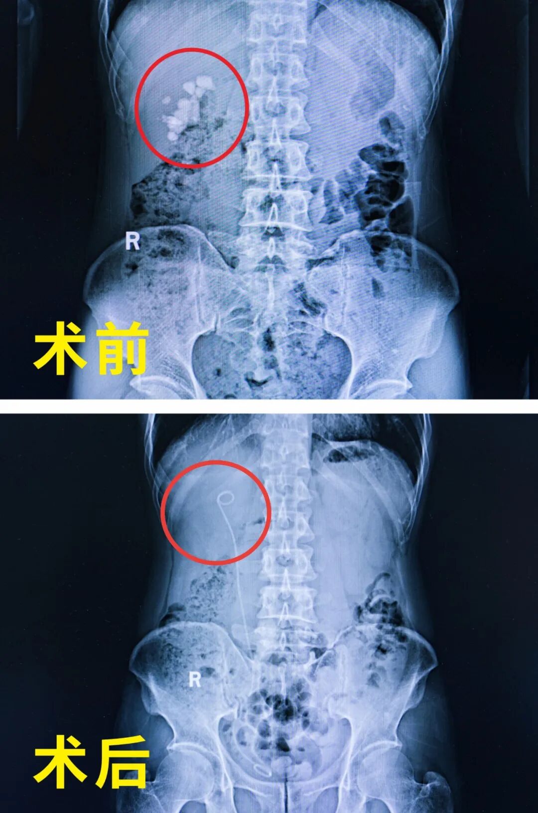 肾里揣着“鹌鹑蛋”，手术排队一个月？我院为治疗按下“加速键”(图3)