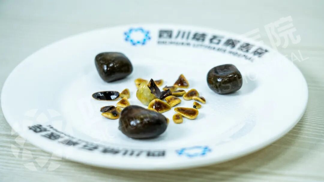 26颗胆结石形如板栗松子 医生提醒:和这些原因密切相关(图1) 26颗胆结石形如板栗松子 医生提醒:和这些原因密切相关(图1)