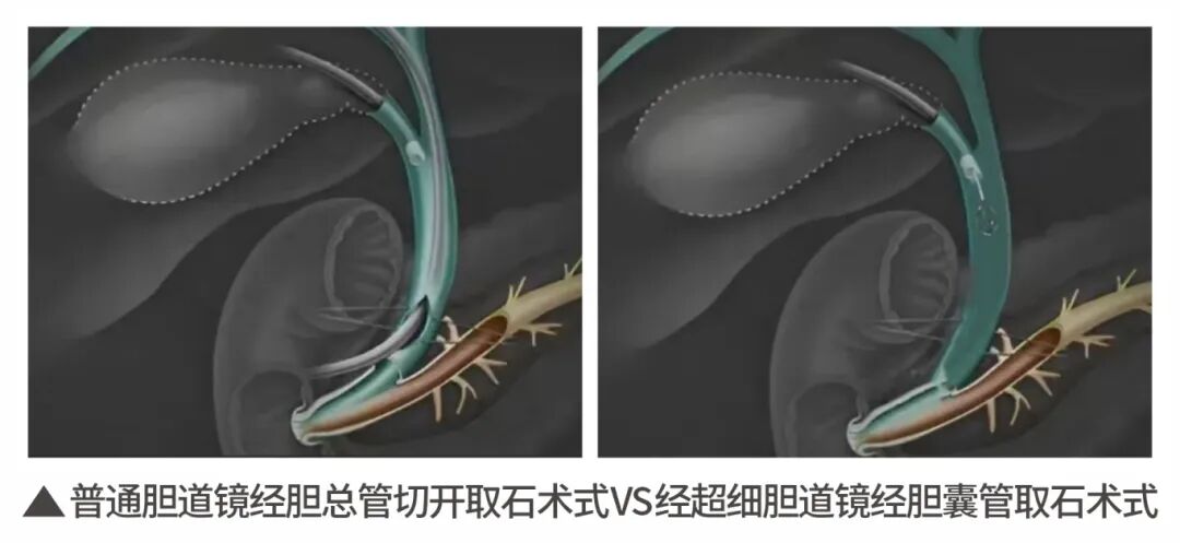 2025年度|四川结石病医院肝胆外科：深耕亚专科，绘就精准医疗蓝图(图13)