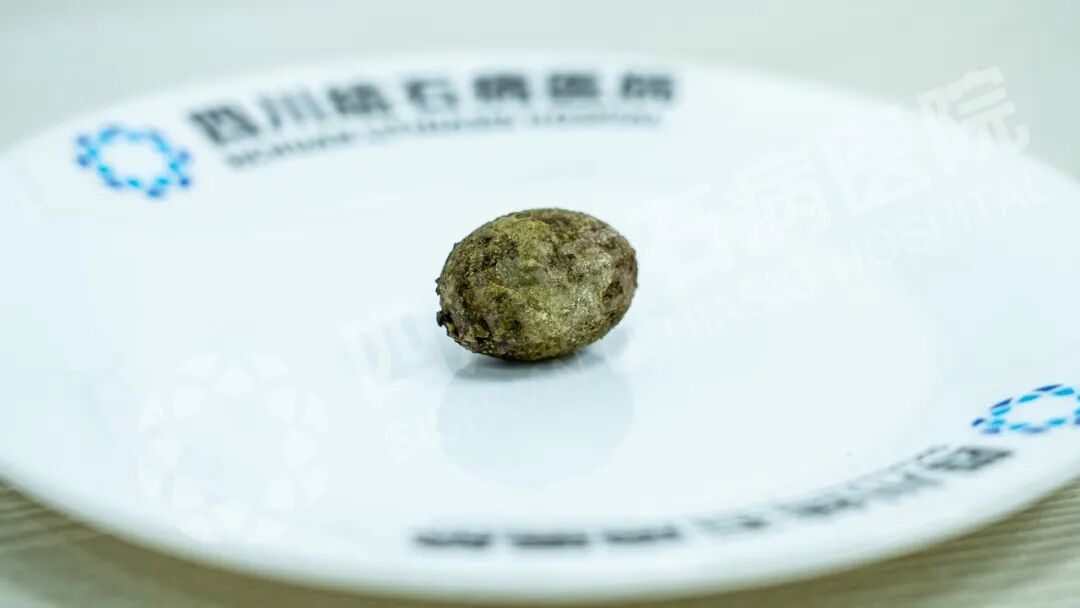 奔波求医路：广元大姐专程来蓉保胆，取出“皮蛋”状结石【四川保胆取石医院】(图3)