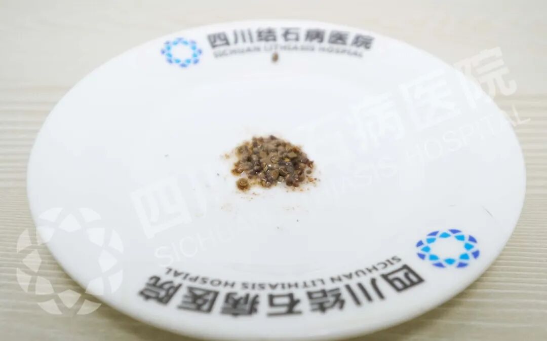 3年拖延，结石疯长4倍！(图1)
