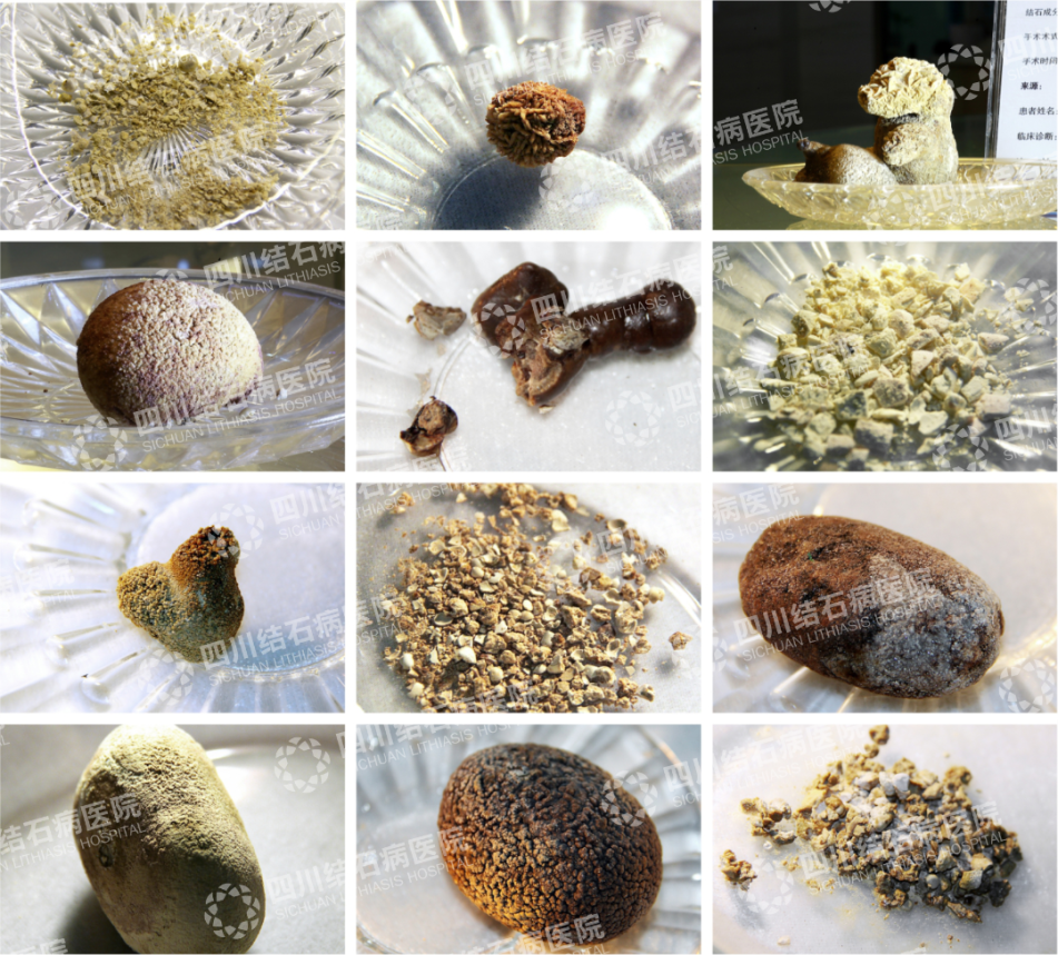 3年拖延，结石疯长4倍！(图4)