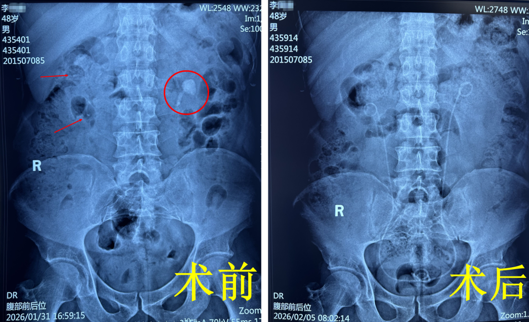 “常年立信高一刀”:春节前的特殊锦旗【四川肾结石专科医院】(图4) “常年立信高一刀”:春节前的特殊锦旗【四川肾结石专科医院】(图4)