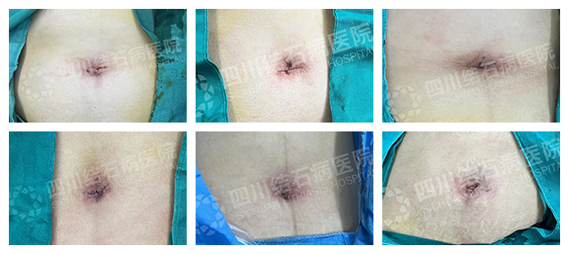 胆结石不痛,为啥还要手术?背后真相很多人不知道 | 四川结石病医院(图5) 胆结石不痛,为啥还要手术?背后真相很多人不知道 | 四川结石病医院(图5)