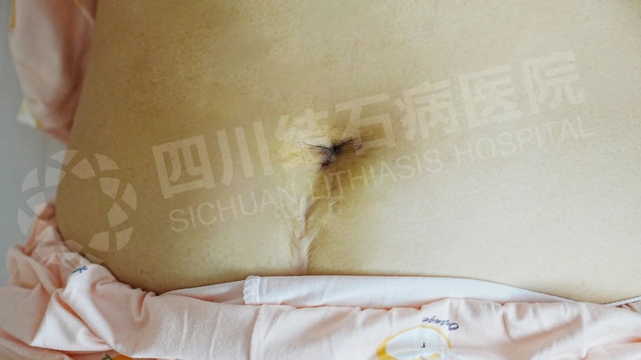 青少年胆结石为何“能保必保”？专家提醒：关乎生长发育与长远健康！【四川结石病医院】(图4)