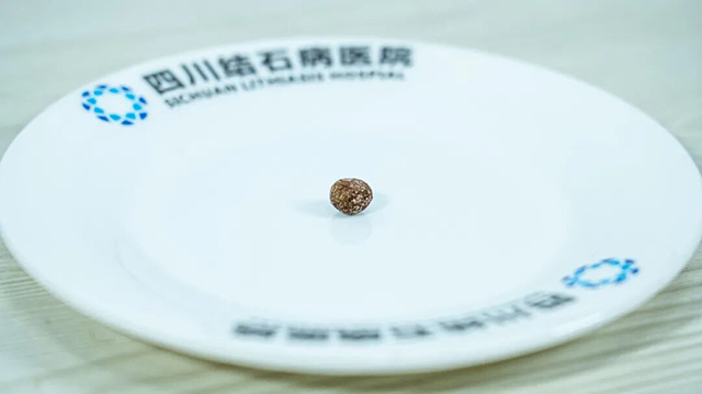 【媒体报道】痛！减肥每天只吃一顿饭，18岁女孩失去这个器官(图3)