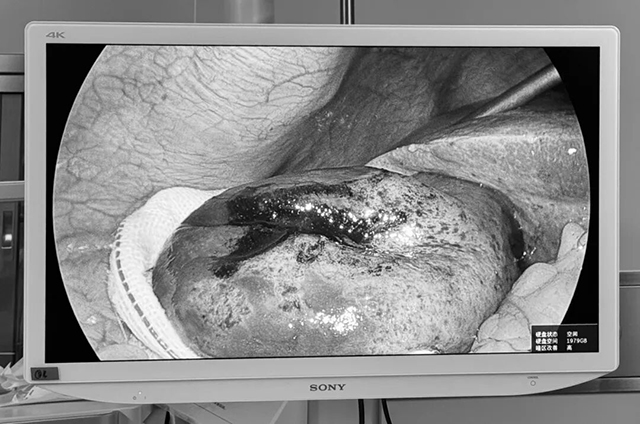 一颗0.6公分胆结石引发的“生命危机”【四川结石病医院】(图3)