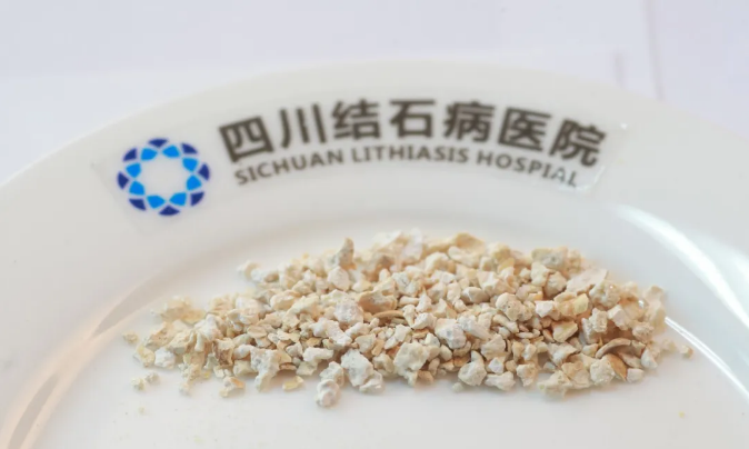 体检查出肾结石，别慌！先搞懂这3件事，少走弯路不遭罪【四川结石病医院】(图2)