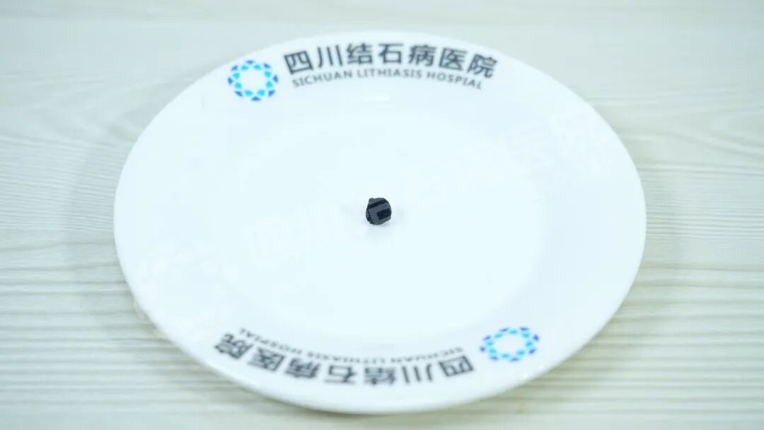 当三名合并严重疾病的患者遇结石,三台“硬仗”如何打赢?(图5) 当三名合并严重疾病的患者遇结石,三台“硬仗”如何打赢?(图5)