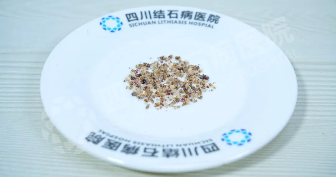 当三名合并严重疾病的患者遇结石,三台“硬仗”如何打赢?(图10) 当三名合并严重疾病的患者遇结石,三台“硬仗”如何打赢?(图10)