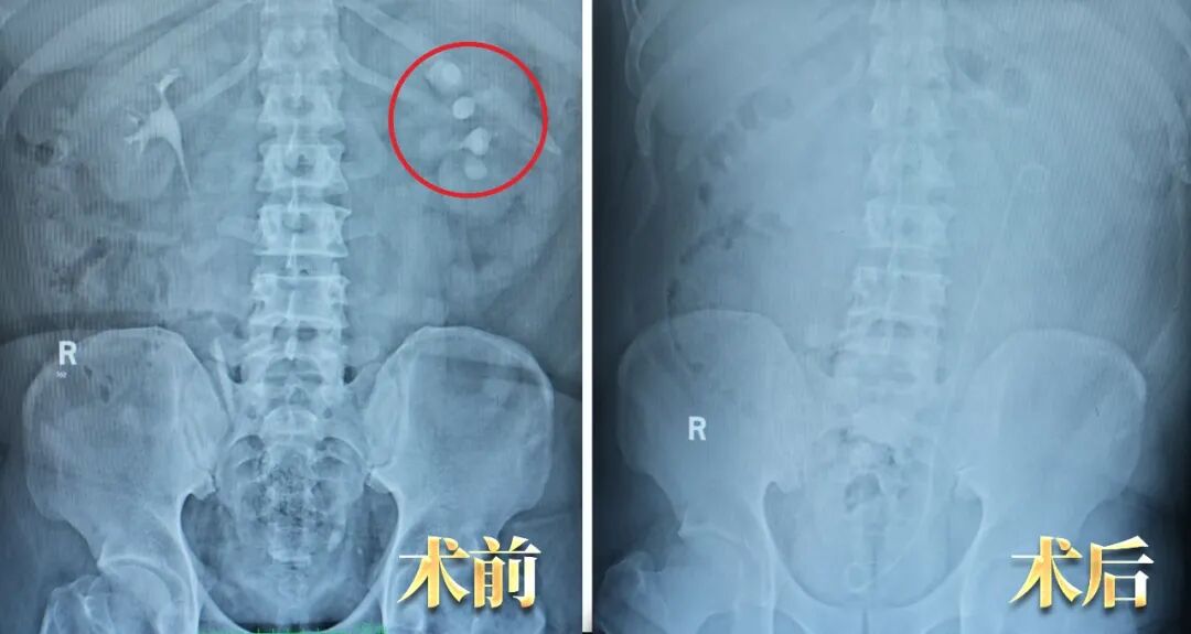 当三名合并严重疾病的患者遇结石,三台“硬仗”如何打赢?(图15) 当三名合并严重疾病的患者遇结石,三台“硬仗”如何打赢?(图15)