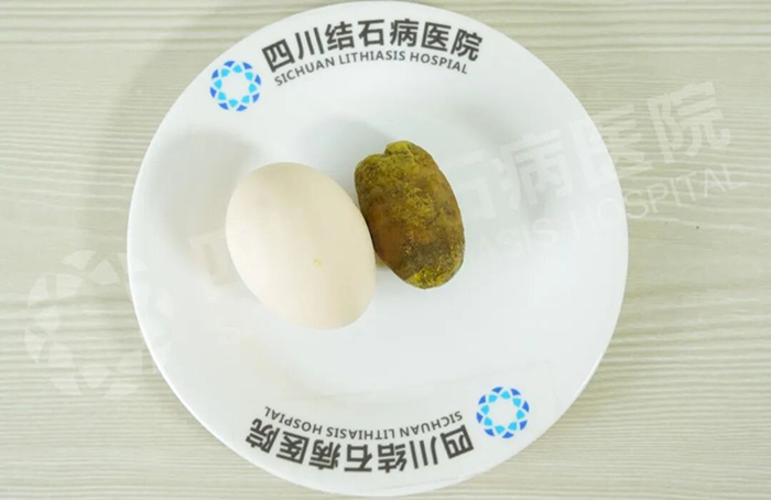 “定时炸弹”被拆除！她在四川结石病医院圆梦保胆(图3)