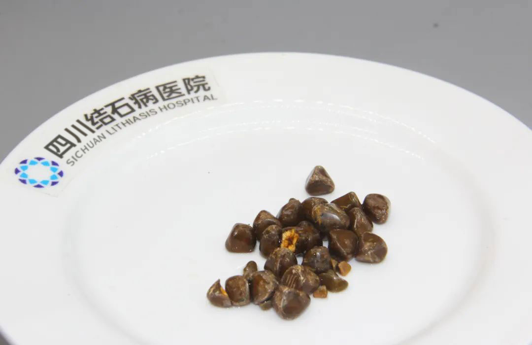 中秋国庆双节将至，四川结石病医院提醒：结石患者节前做好这件事，安心过长假(图3)