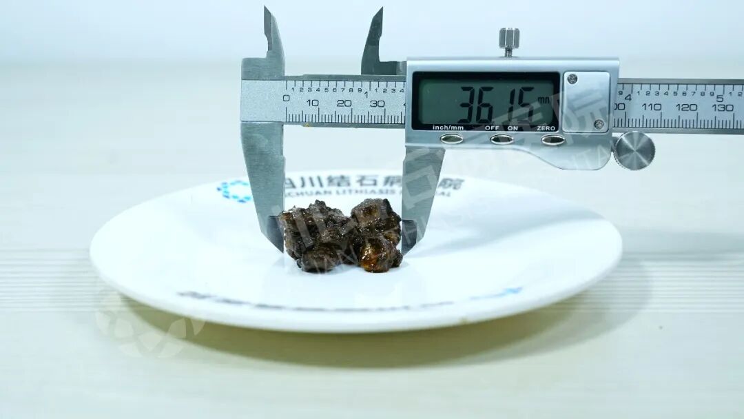 别等痛得打滚才后悔!胆结石查出后,这一步很关键【四川结石病医院】(图1) 别等痛得打滚才后悔!胆结石查出后,这一步很关键【四川结石病医院】(图1)