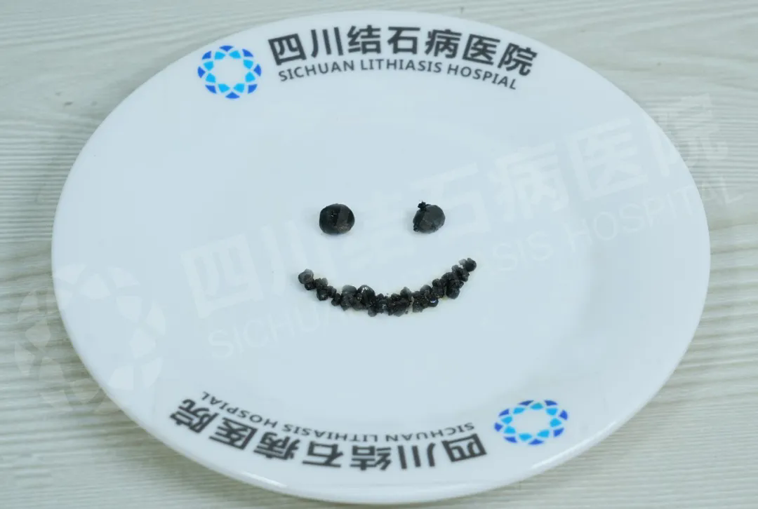 为什么肝内胆管有损伤更要保胆?这台手术,藏着一项复旦研究结论(图1) 为什么肝内胆管有损伤更要保胆?这台手术,藏着一项复旦研究结论(图1)