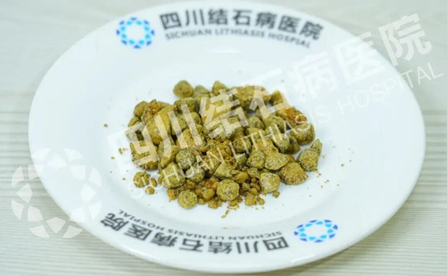 半夜腰杆痛醒?输尿管结石在“搞事”,一定要认清它【成都仅一家结石专科】(图3) 半夜腰杆痛醒?输尿管结石在“搞事”,一定要认清它【成都仅一家结石专科】(图3)
