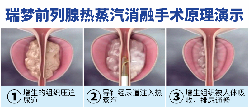 中老年前列腺增生新选择!瑞梦热蒸汽消融,超微创保护功能(图2) 中老年前列腺增生新选择!瑞梦热蒸汽消融,超微创保护功能(图2)