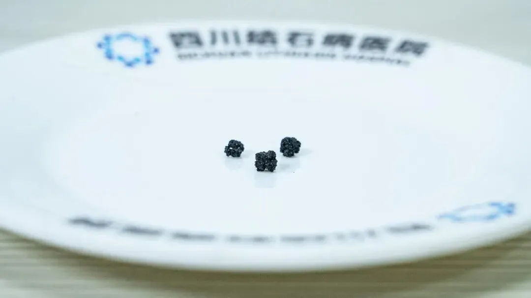不吃早餐到底有多伤胆？成都27岁患者的真实经历值得警惕【成都只有一家结石专科】(图1)