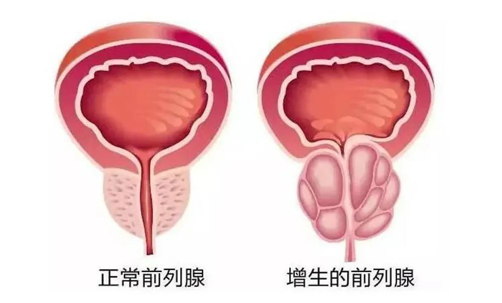 男人一生要闯的“前列腺关”，40岁后更要上心【四川瑞梦热蒸汽消融术医院】(图1)